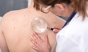 Doctor examing patient for melanoma
