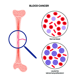 illustration of leukemia