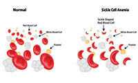 Sickle Cell Anemia Graphic