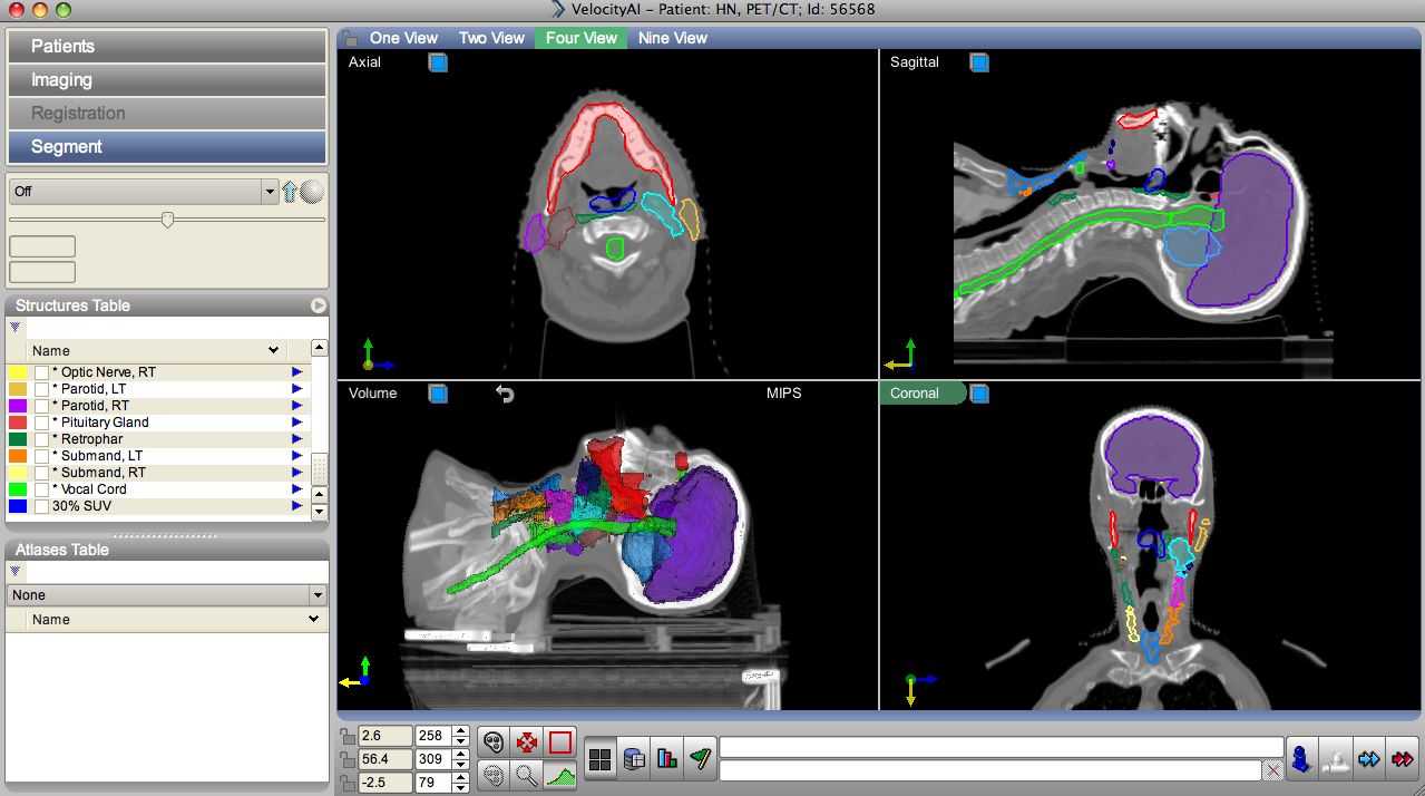 Computer screen showing segmented head and neck scans in axial, sagittal, coronal, and volume views.