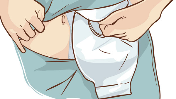 Generic Ostomy Illustration